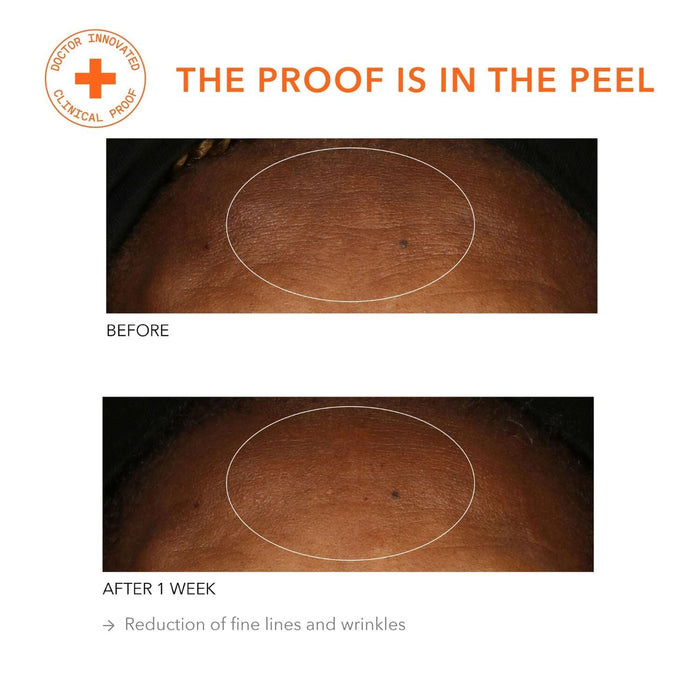 Dr. Dennis Gross Skincare Alpha Beta Universal Daily Peel (30-60 treatments) Pads & Peels Dr. Dennis Gross