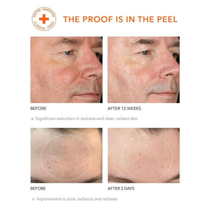 Dr. Dennis Gross Skincare Extra Strength Alpha Beta Peel (30-60 treatments) Pads & Peels Dr. Dennis Gross